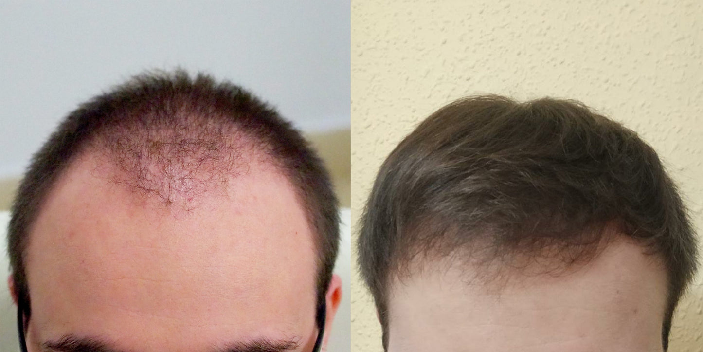 ACEITE ANTICAÍDA PARA EL CABELLO