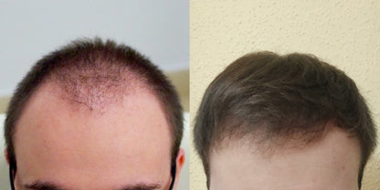 ACEITE ANTICAÍDA PARA EL CABELLO