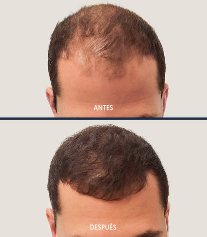 ACEITE ANTICAÍDA PARA EL CABELLO